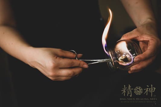 Fire Cupping with Acupuncture