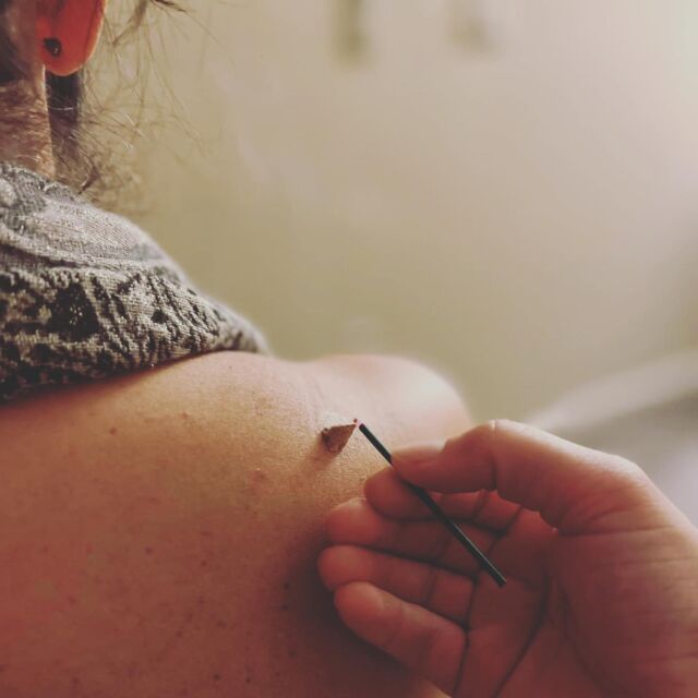 Treat the Patient, Not the Condition...

As with any chronic condition, treatment is never as simple as "...treating ______ (symptom/condition)..."

CLASSICAL FIVE ELEMENT ACUPUNCTURE teaches us that each patient who makes their way into our office has a unique story and experience of their symptoms.