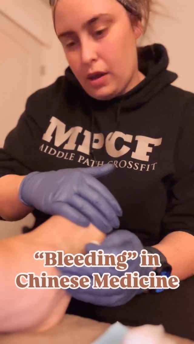 This video demonstrates a traditional Chinese medicine technique known as bleeding therapy, using pricking and superficial vein methods.

By releasing a small amount of blood—just a few drops—this approach helps promote circulation, clear heat, and move stagnation. 

Bleeding therapy is used selectively in specific clinical cases and is performed with sterile technique, precision, and patient comfort as priorities.

✨ Sometimes, a small release can go a long way toward promoting circulation, relieving discomfort, and supporting the body’s natural return to balance✨